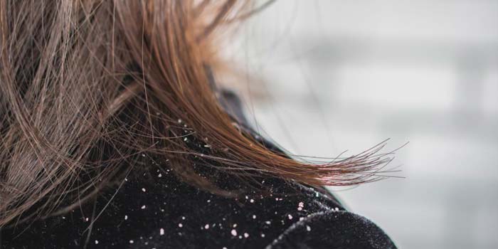 Dandruff Issues